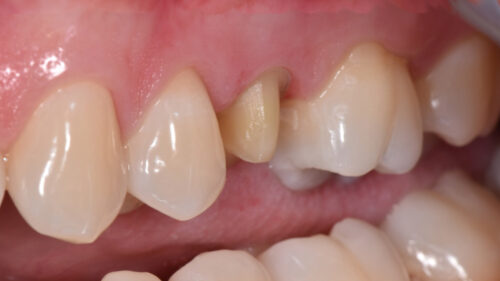 Dental prosthesis - Implant