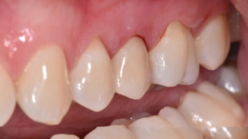 Dental prosthesis - Implant placed