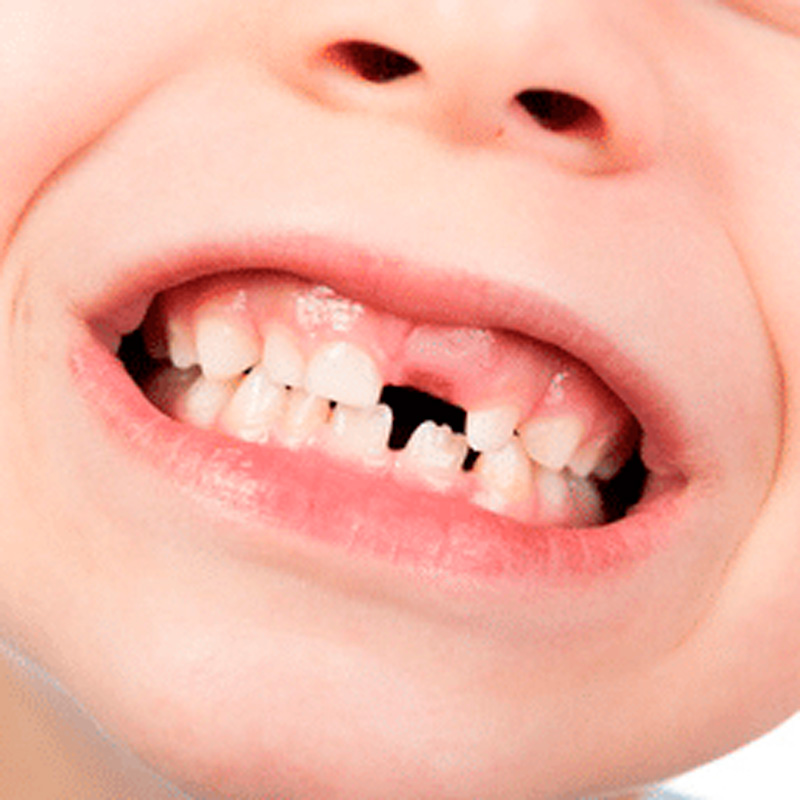 Dentista-Infantil---Traumatismo-dental